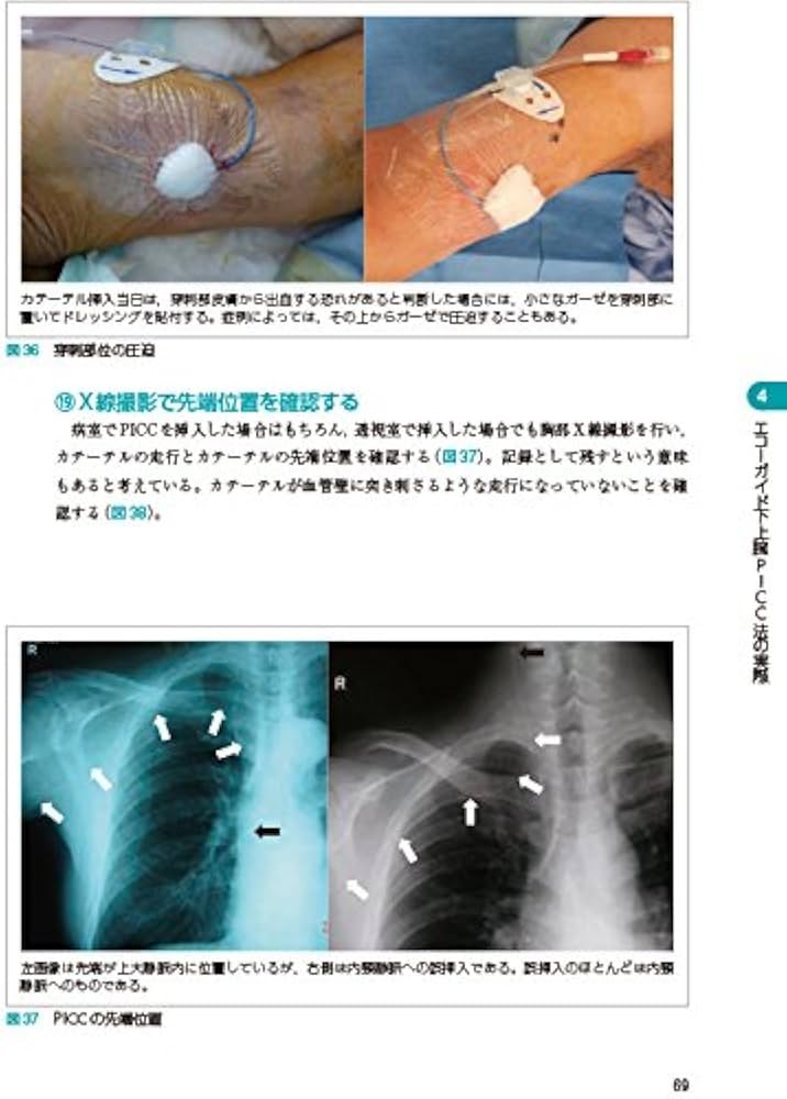 PICC 末梢挿入式中心静脈カテーテル管理の理論と実際 PICC末梢挿入式中心静脈カテ－テル管理の理論と実際 / 井上